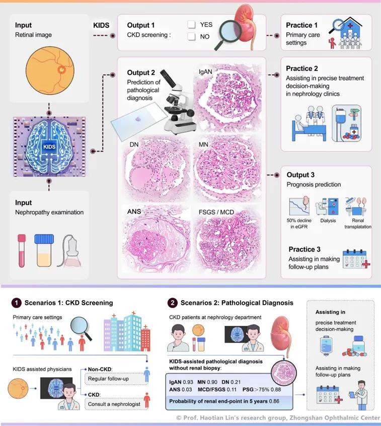 KIDS assists doctors in chronic kidney disease screening, pathological diagnosis, and prognosis prediction